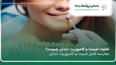 تفاوت لمینت و کامپوزیت دندان چیست؟