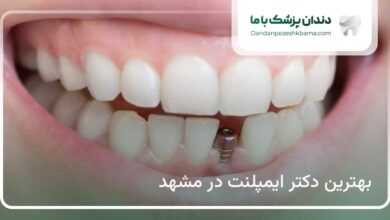 بهترین دکتر ایمپلنت در مشهد