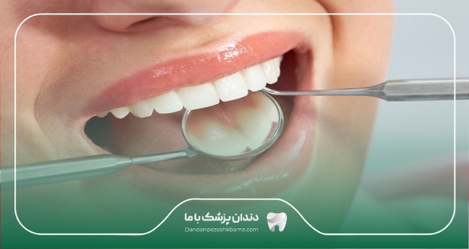 هزینه کامپوزیت دندان در سال 1404