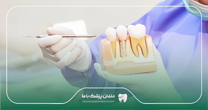 هزینه ایمپلنت دندان در زعفرانیه چقدر است؟