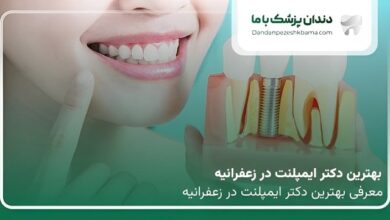 بهترین دکتر ایمپلنت در زعفرانیه