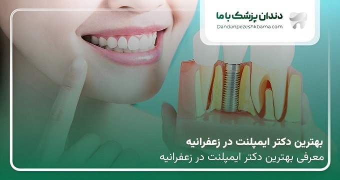 بهترین دکتر ایمپلنت در زعفرانیه