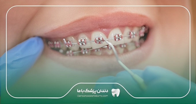 هزینه درمان بهترین دکتر ارتودنسی در ایران