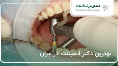 بهترین دکتر ایمپلنت در ایران