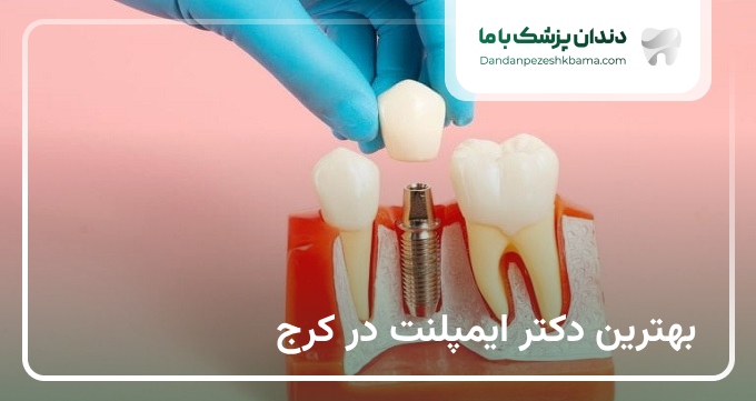 بهترین دکتر ایمپلنت در کرج