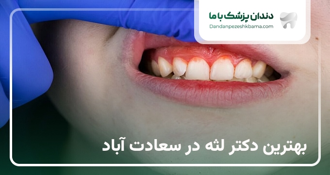 بهترین دکتر لثه در سعادت آباد
