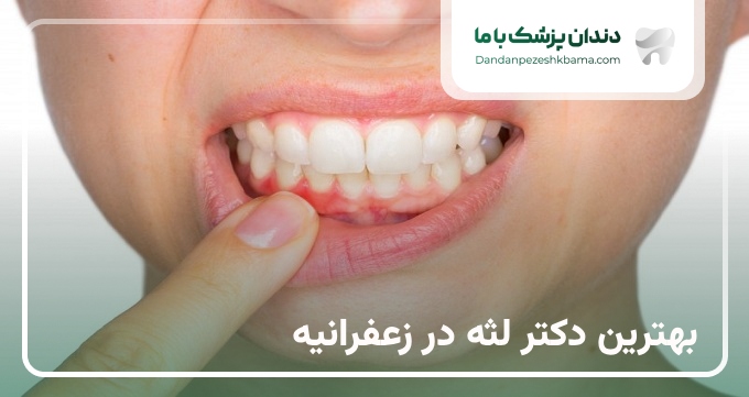 بهترین دکتر لثه در زعفرانیه