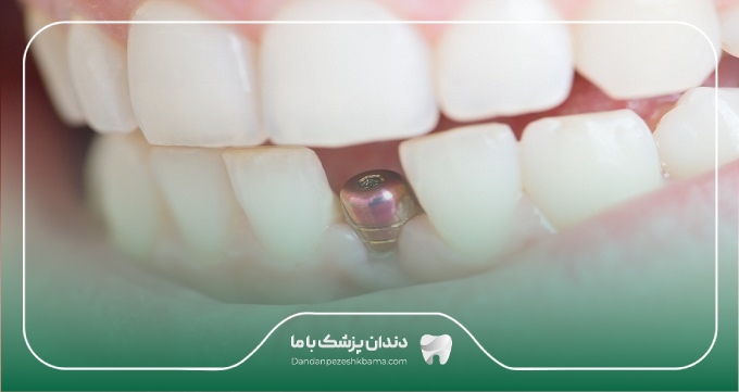 عوامل موثر بر هزینه خدمات بهترین دکتر ایمپلنت در نیاوران