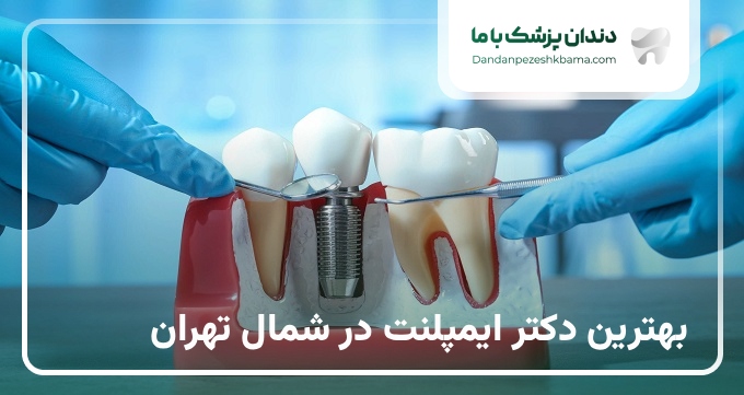 بهترین دکتر ایمپلنت در شمال تهران