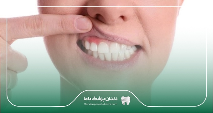 عوامل موثر در هزینه جراحی لثه در زعفرانیه