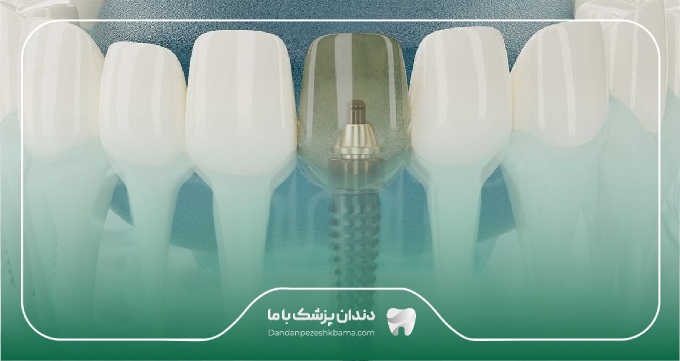 تعرفه خدمات ایمپلنت در تجریش