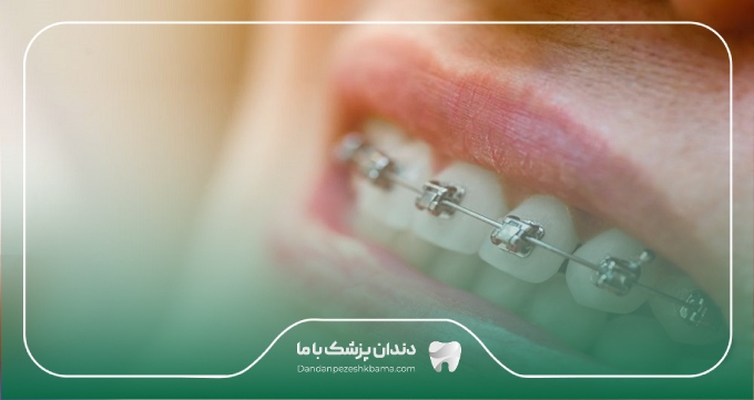 مراقبت های بعد از ارتودنسی